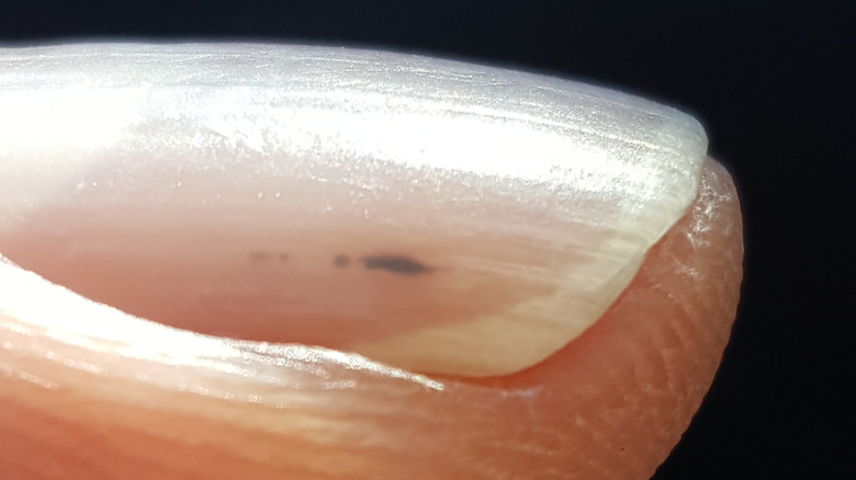 splinter hemorrhage on nail