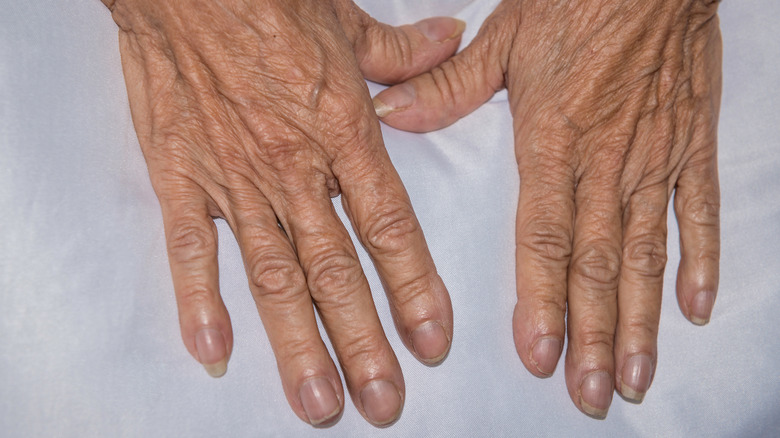 photo of woman's hands with clubbed nails