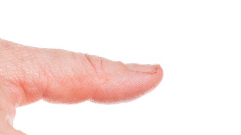 image of thumb with spoon nail