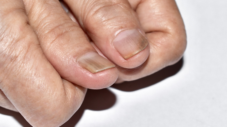 nail separation in thumb nails