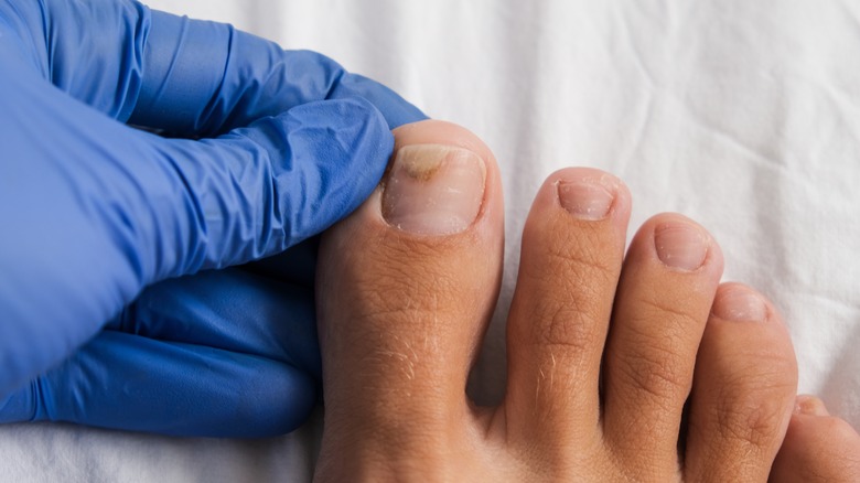 Infected toenail