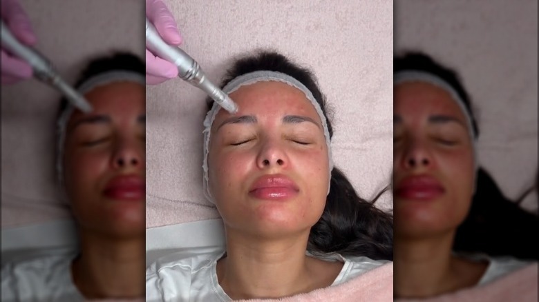 A woman undergoing Microneedling