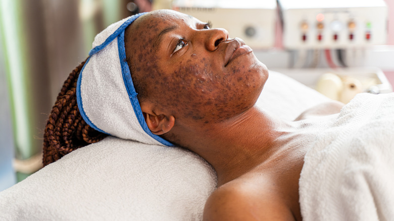 Woman with acne scars 