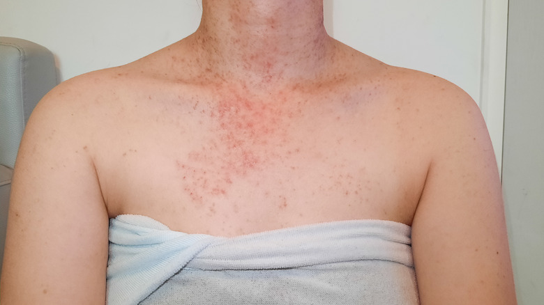 Fungal acne on a woman's chest