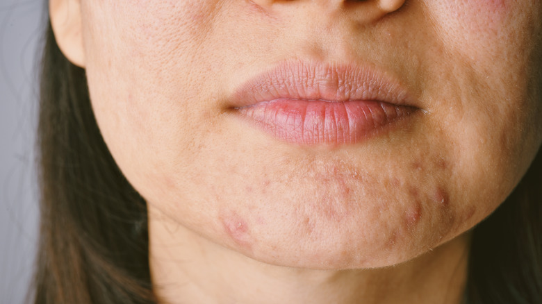 Close up of woman with hormonal acne