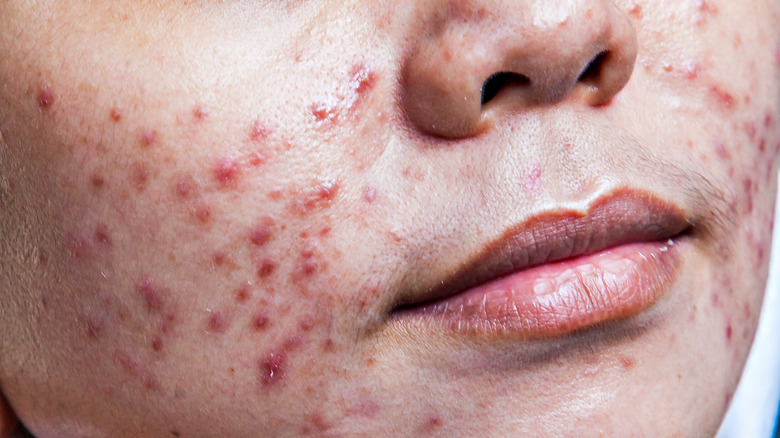 Close up of woman with nodular acne