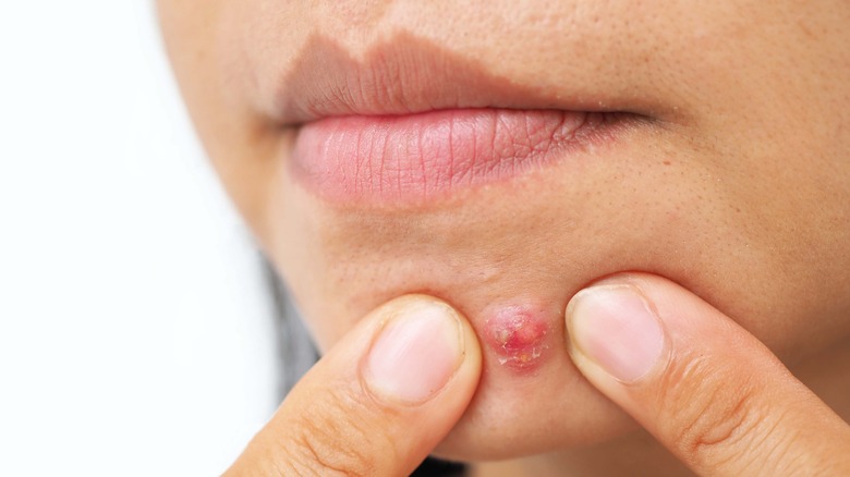 Close up of a pimple on a woman's chin