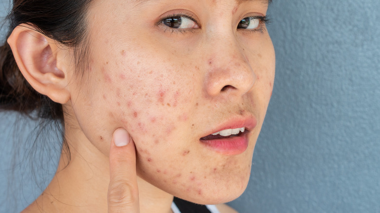 Woman with pimples