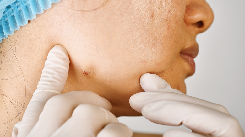 Dermatologist examining cystic acne