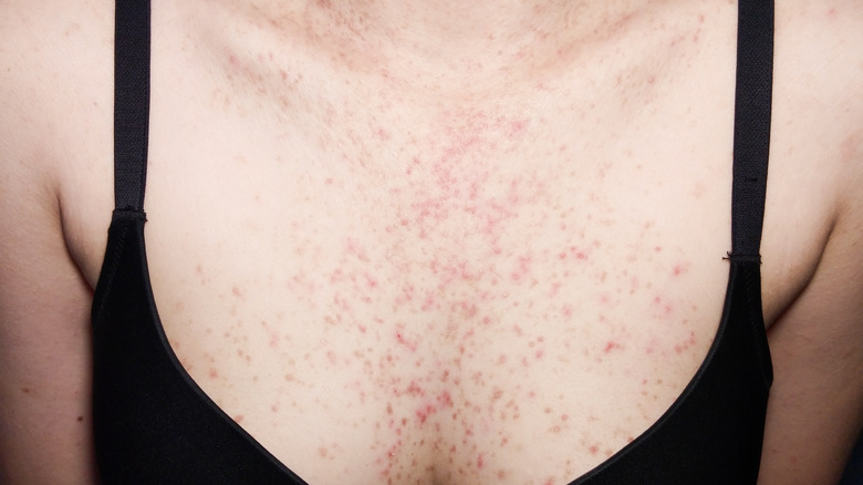 Fungal acne on a woman's chest