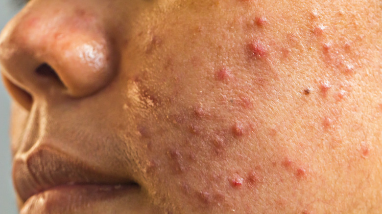 Close up of a woman with nodular acne