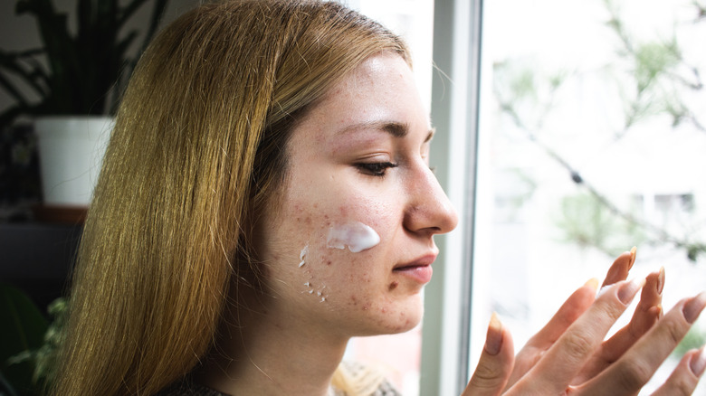 Woman putting topical cream on acne