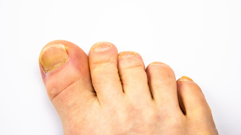 Toenails with fungal infection