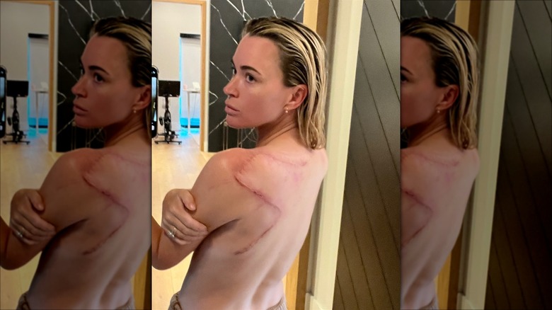 Teddi Mellencamp showing her scar