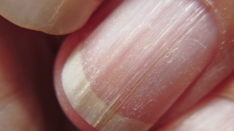 Fingernails with vertical ridges
