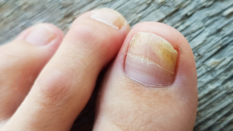 Close-up of dry, yellowed toenails