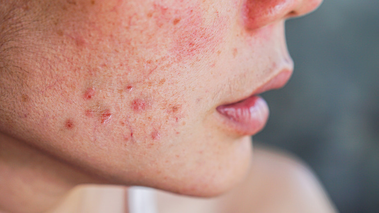Woman with cheek acne