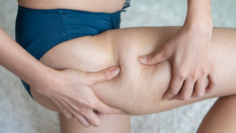 woman holding her leg cellulite 
