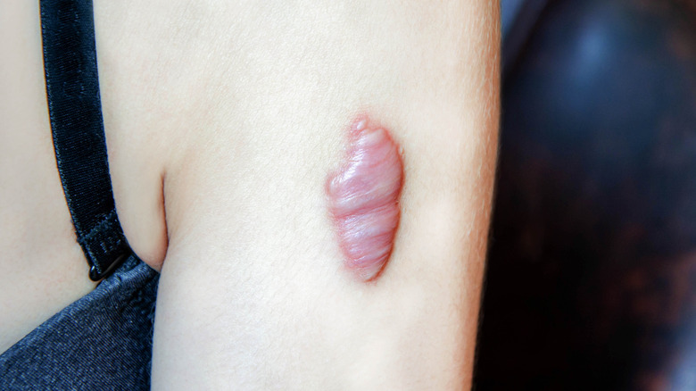 A woman with a keloid on her arm