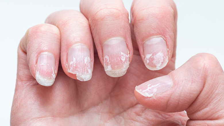 Close-up of nearly closed hand with damaged nails