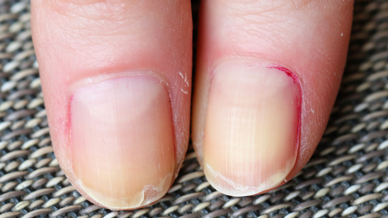 woman with brittle weak nails