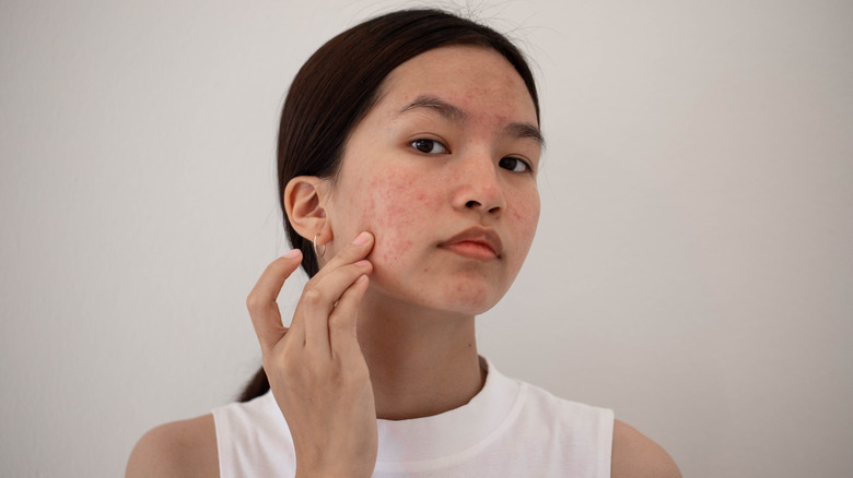 Acne prone skin