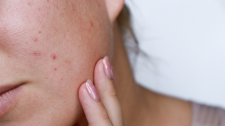 Person with acne on their skin