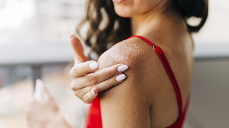 Woman applying moisturizer to sunburned skin