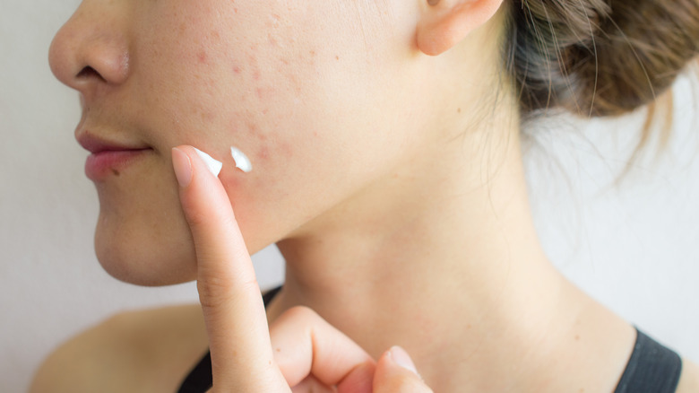 A woman applying spot treatment on her face