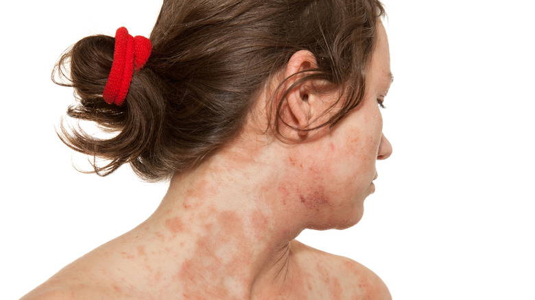 Woman with dermatitis