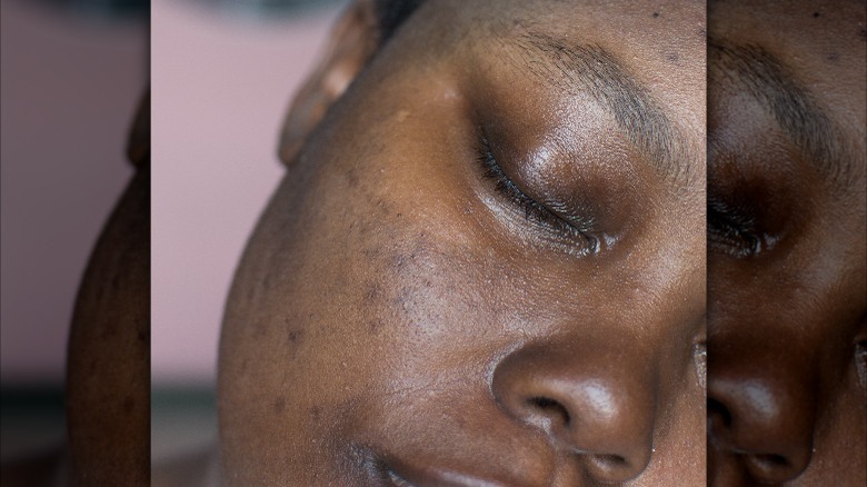 Woman with melasma on her face 