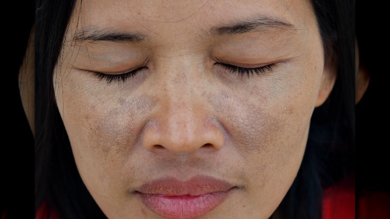 Woman with melasma on her face 