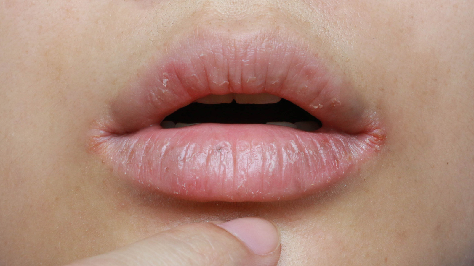 What Causes Red Swollen Chapped Lips Infoupdate