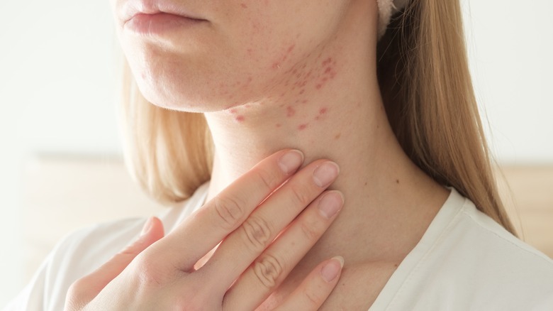 Woman with cystic acne
