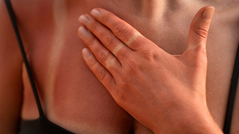 Sunburned hand and chest