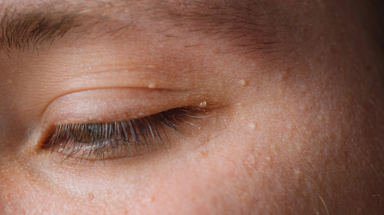 A close-up image of an individual with milia under the eyes