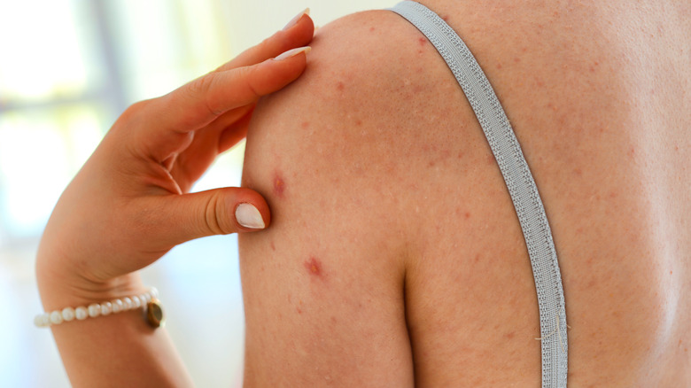 body acne on woman's shoulders