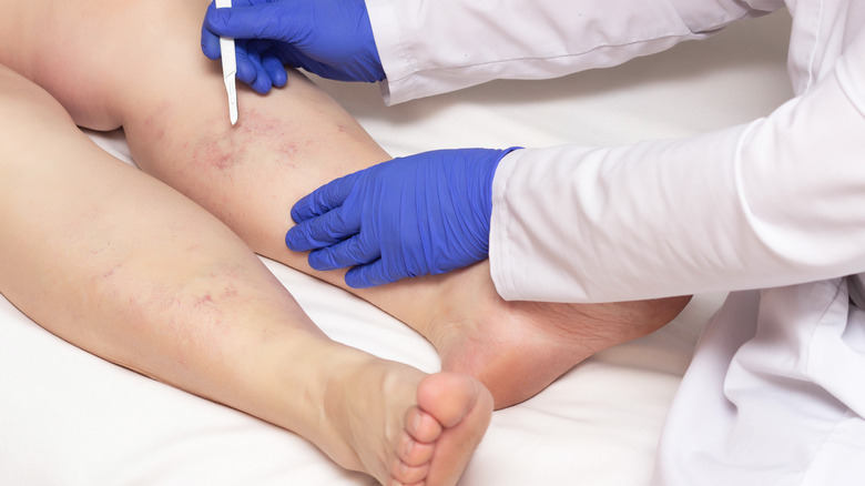 Doctor treating vein in leg