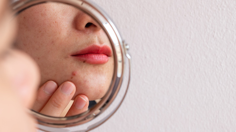 Woman with acne looking into mirror