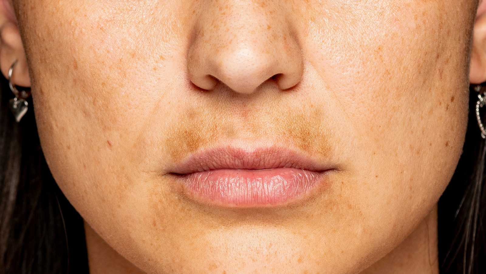 Treatments To Try To Clear Up Skin Discoloration