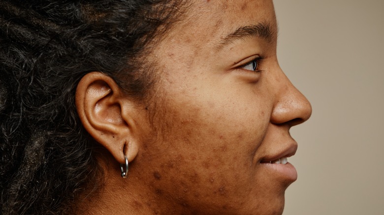 woman with acne scars
