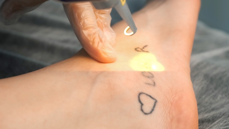 Foot tattoo laser removal