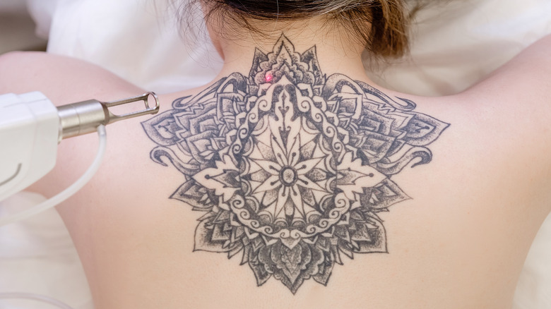 Patterned tattoo on back being removed