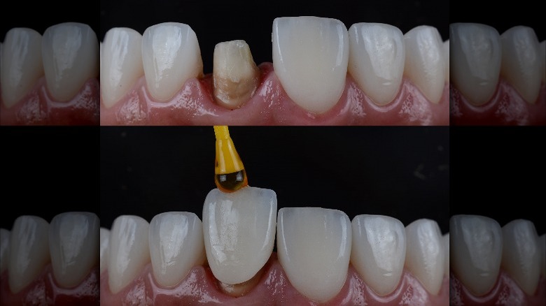 Crown fitted over shaved tooth