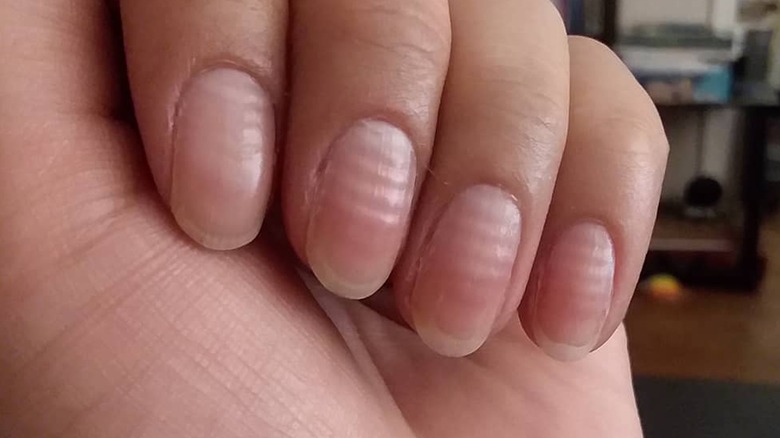 What It Really Means When Ridges Appear On Your Nails