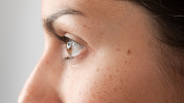 woman with sunspots or freckles