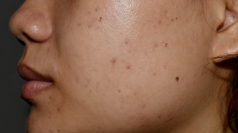 Person with melasma