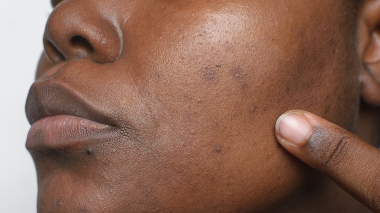 Person with hyperpigmentation